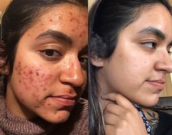 Before and After Images of Our Clients at Arden Creek Laser & Aesthetics in Sacramento, CA width=