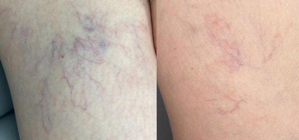 Before and After Images of Our Clients at Arden Creek Laser & Aesthetics in Sacramento, CA width=