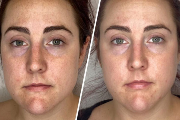 Before and After Images of Our Clients at Arden Creek Laser & Aesthetics in Sacramento, CA width=