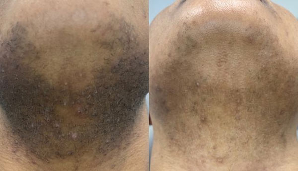 Before and After Images of Our Clients at Arden Creek Laser & Aesthetics in Sacramento, CA width=