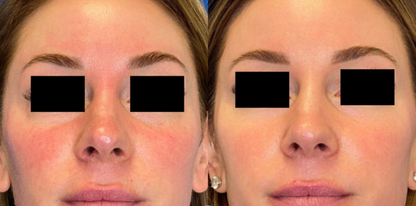 Before and After Images of Our Clients at Arden Creek Laser & Aesthetics in Sacramento, CA width=