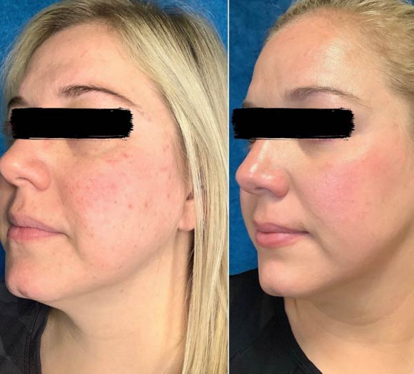Before and After Images of Our Clients at Arden Creek Laser & Aesthetics in Sacramento, CA width=